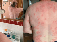 Brecon man survives more than 160 wasp stings thanks to MIU nurses