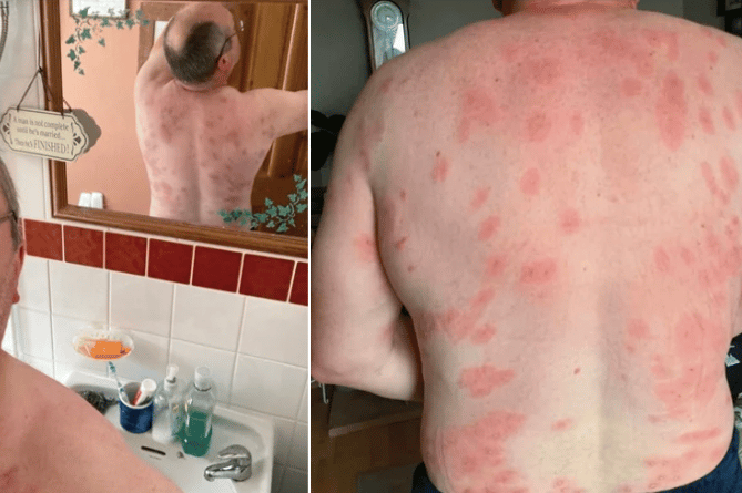 Andrew Powell 160+ wasp stings