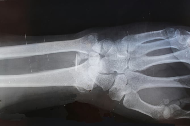 X-ray